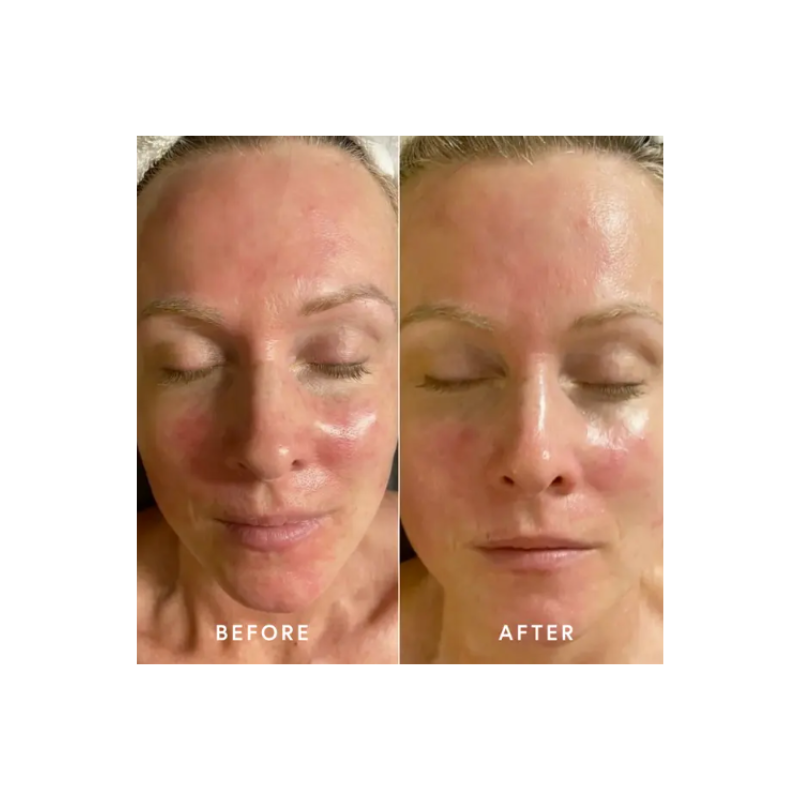 Epicutis Post Procedure Kit 3